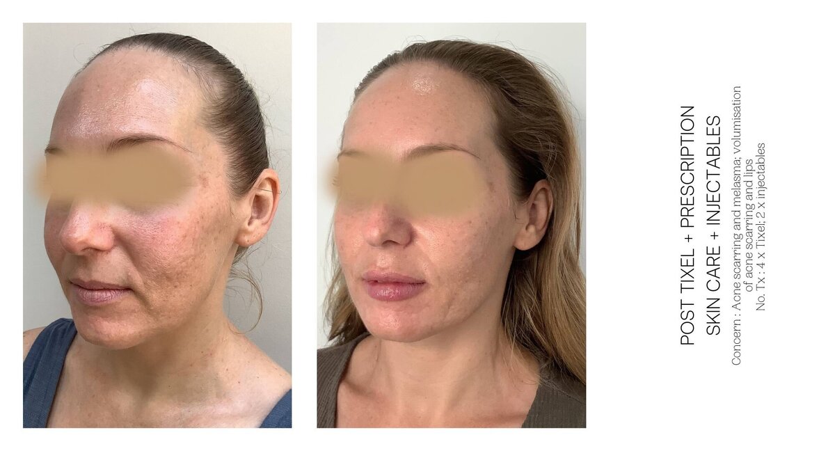 Acne Scarring Before and After 2