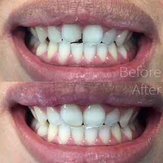 6c4_before-after-2-bonded20filling20on20a20chipped20upper20front20tooth.JPEG