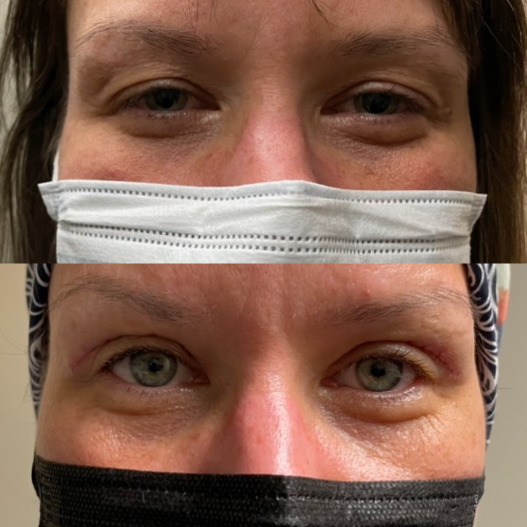 2 weeks postop bilateral blepharoplasty