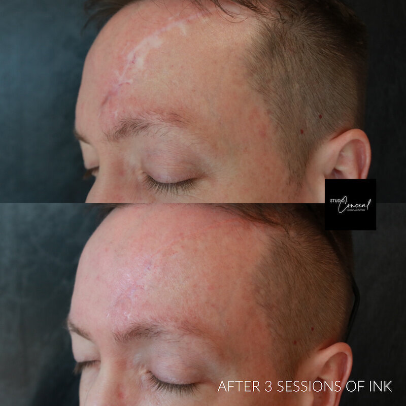 cancer-removal-scar-forehead-revision-1