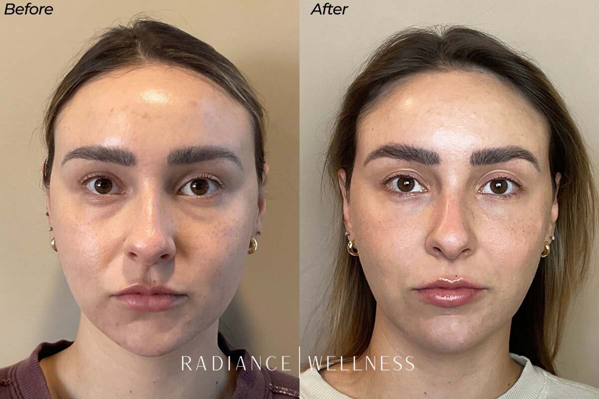 PRF EZ Gel (Slider)