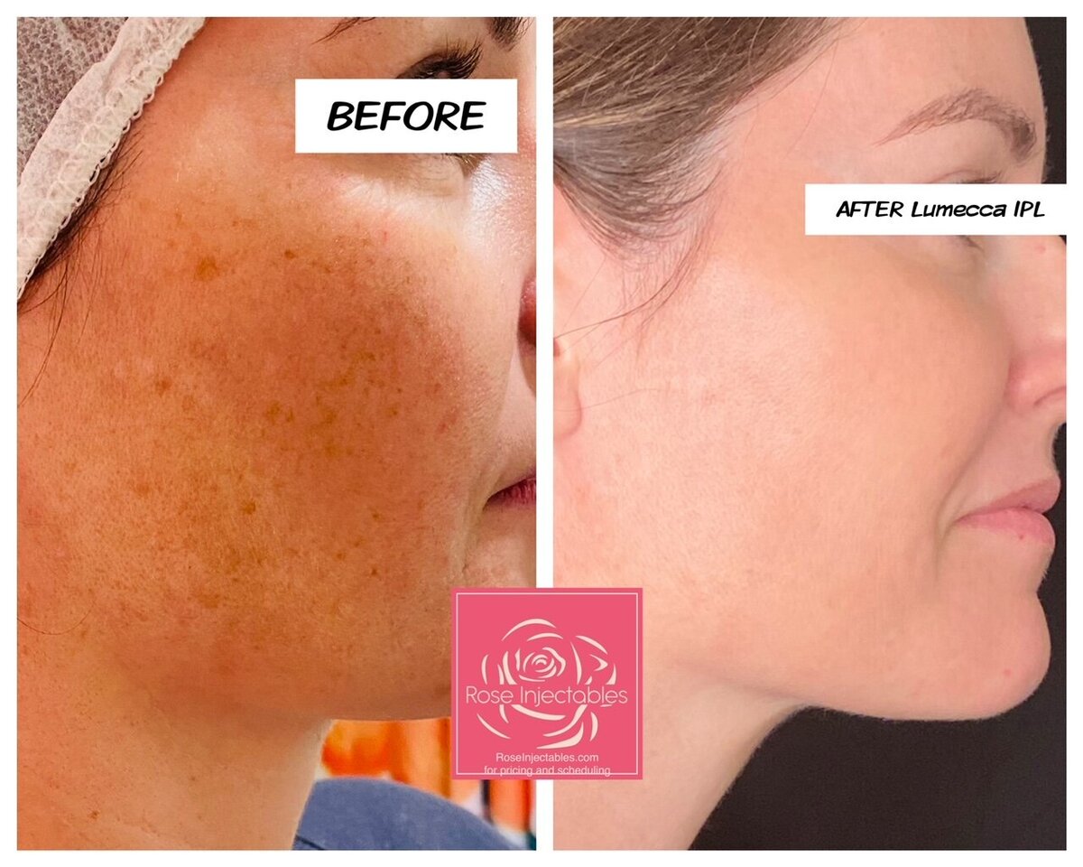 Lumecca-by-Rose-Injectables-Dark-Spot-Removal-Before-and-After-Photos-20