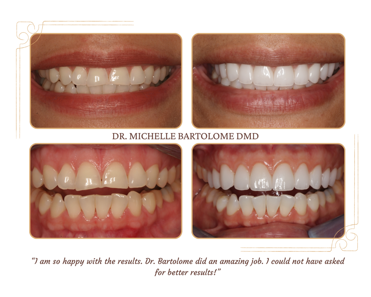 Porcelain Crowns and Veneers (1)