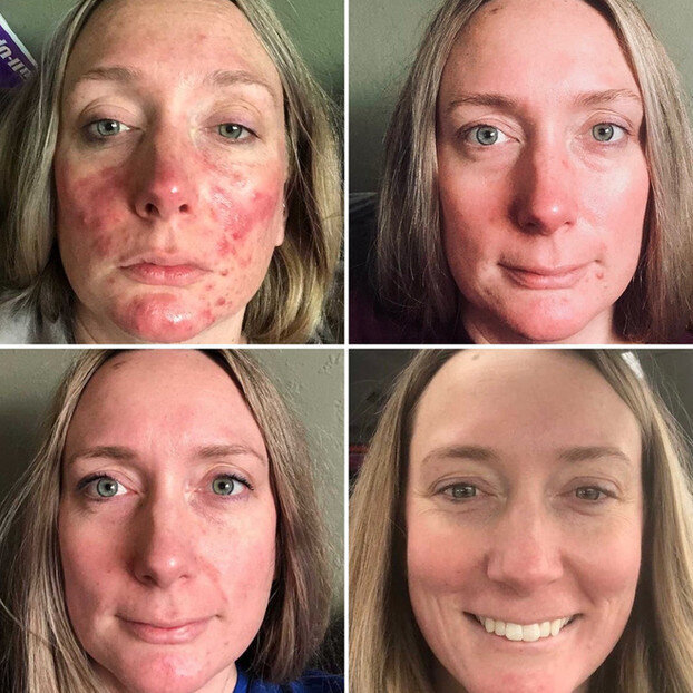 Holistic Services The Rosacea Method Dr. Tara O'Desky