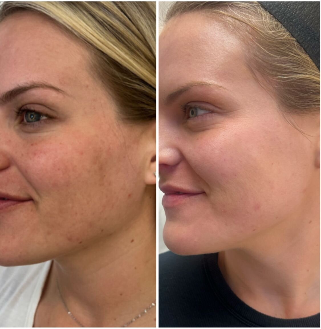 compressed-Moxi- BBL-before-after-15