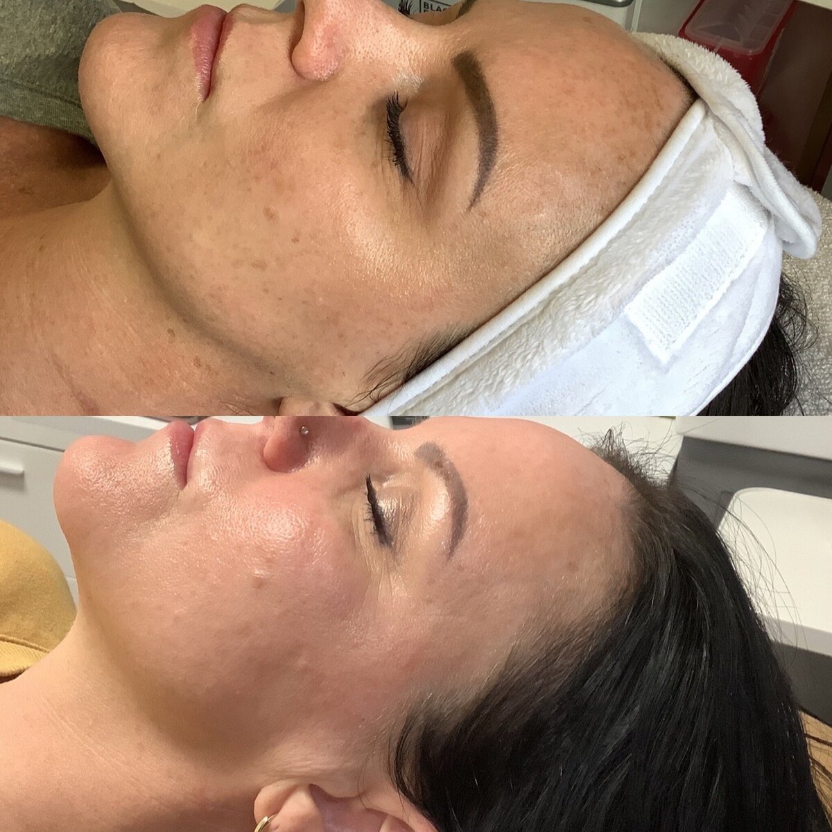 IPL and VI Peel combo