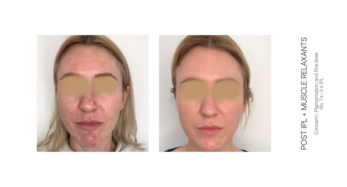 Skin Pigmentation and Fine Line Before and After 3