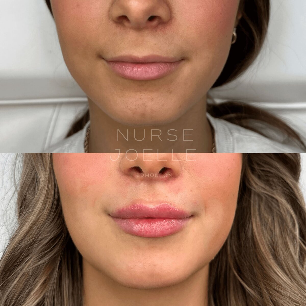 Nurse-Joelle-Cosmetic-Injectables-Before-and-After-18