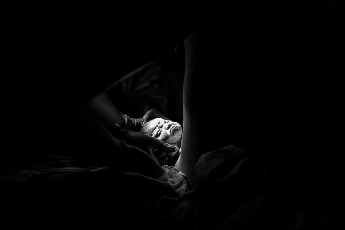 Black and white image of an IVF baby crowning during birth at Michael Garron Hospital in Toronto — a powerful, emotional moment captured with dramatic light