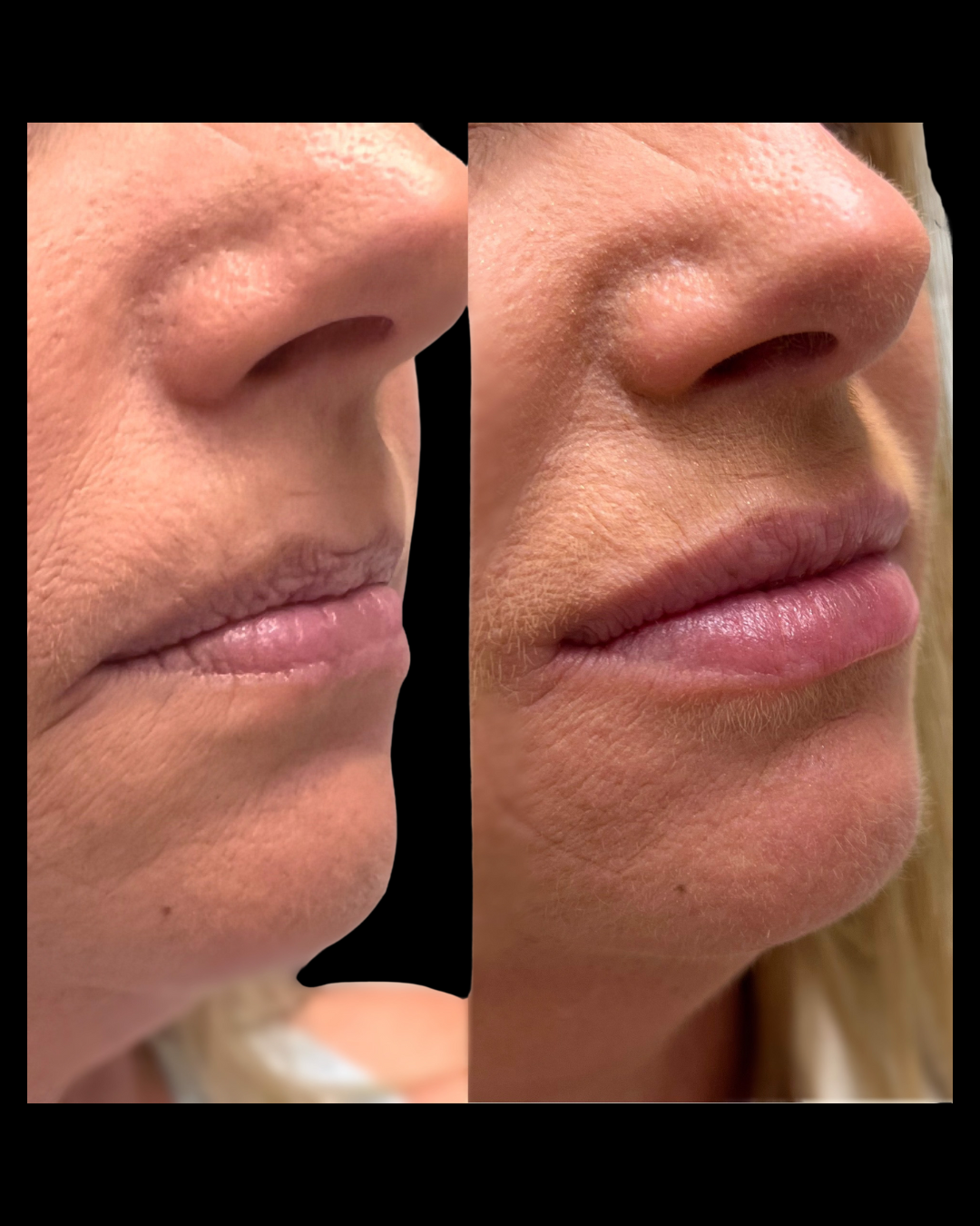 Close-up before and after of lip filler enhancement, improving shape and volume