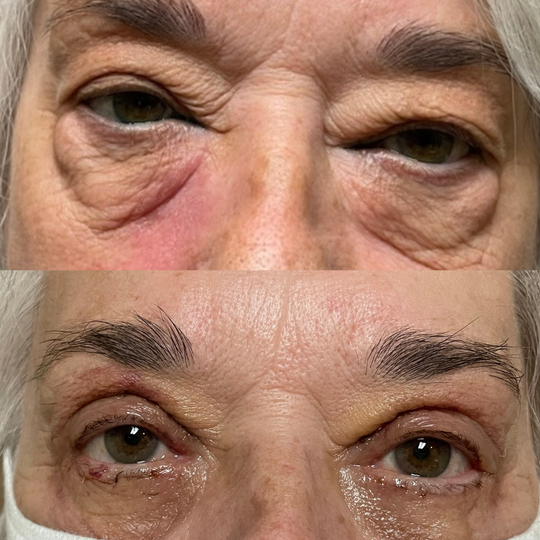 2 weeks after an upper and lower eyelid blepharoplasty