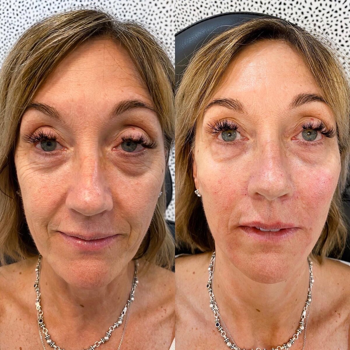 BalancedBeautyBotoxWestwood3