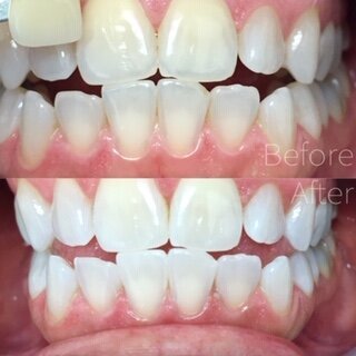 5bbd29cbae9b4580f2716bff_before-after-11-zoom-whitening.JPEG