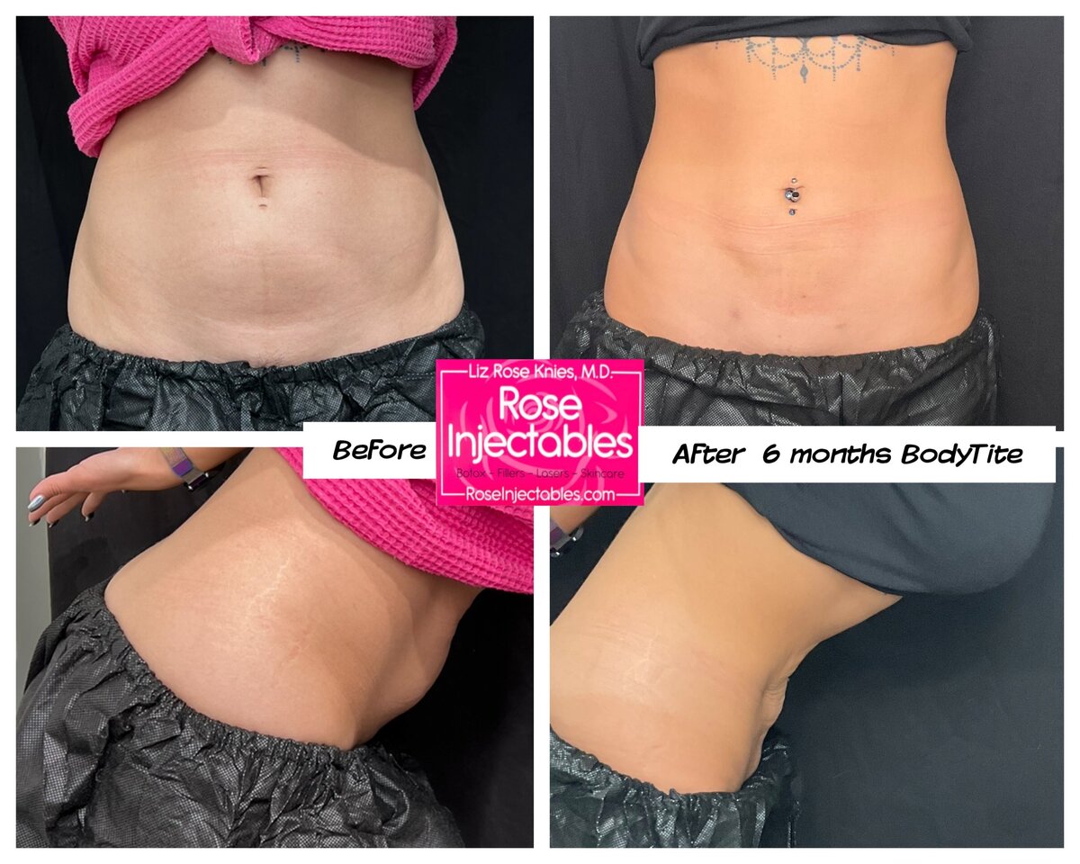 BodyTite-by-Rose-Injectables-Minimally-Invasive-Body-Contouring-Before-and-After-Photos-21