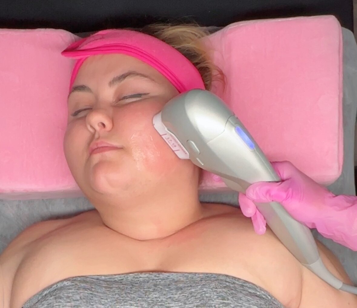woman HIFU facial treatment