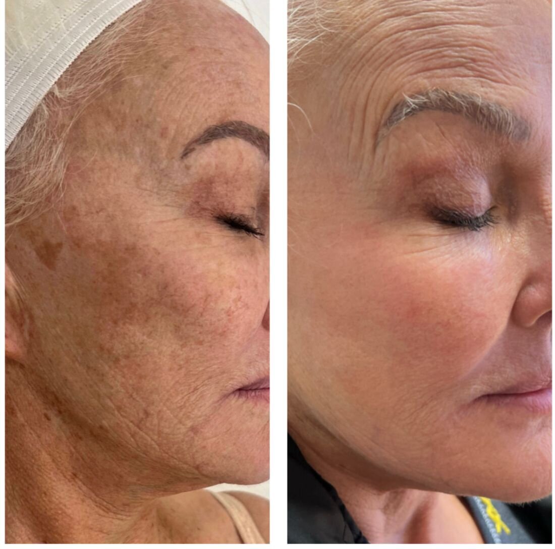 compressed-BBL-HALO-before-after-02