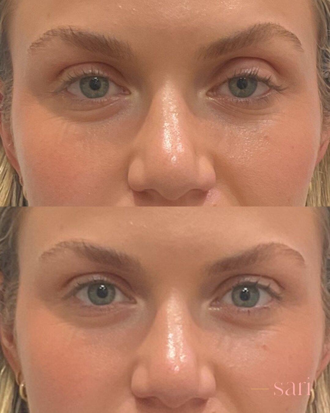 Upneeq before and after 2