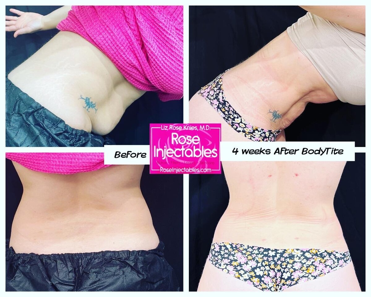 BodyTite-by-Rose-Injectables-Minimally-Invasive-Body-Contouring-Before-and-After-Photos-67