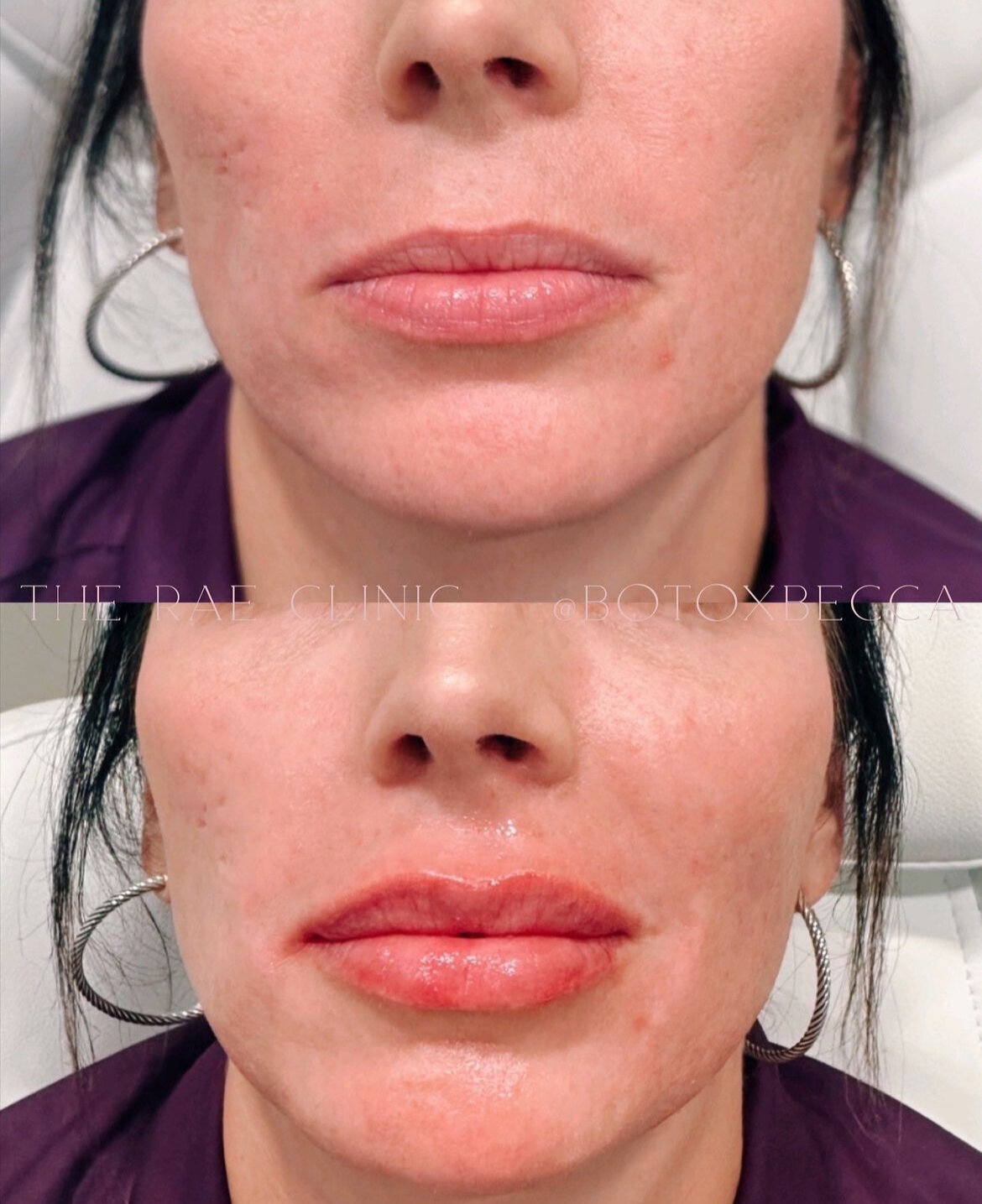 Lip Filler by Rebecca Williford at The Rae Clinic in Augusta, Georgia