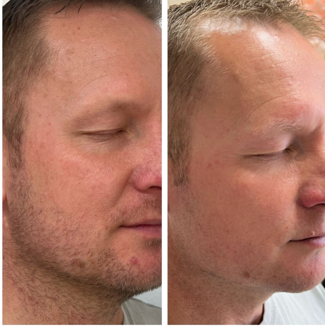 compressed-missing-laser-images-before-after-03