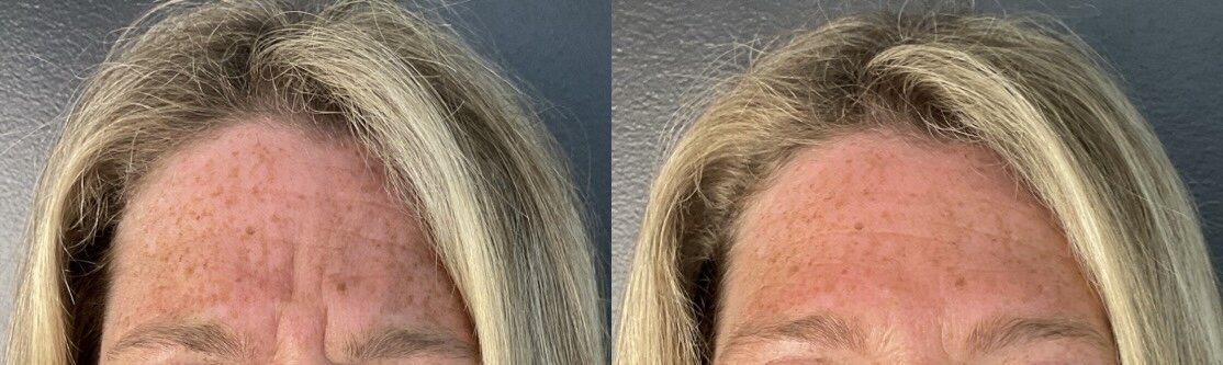botox to forehead and glabella
