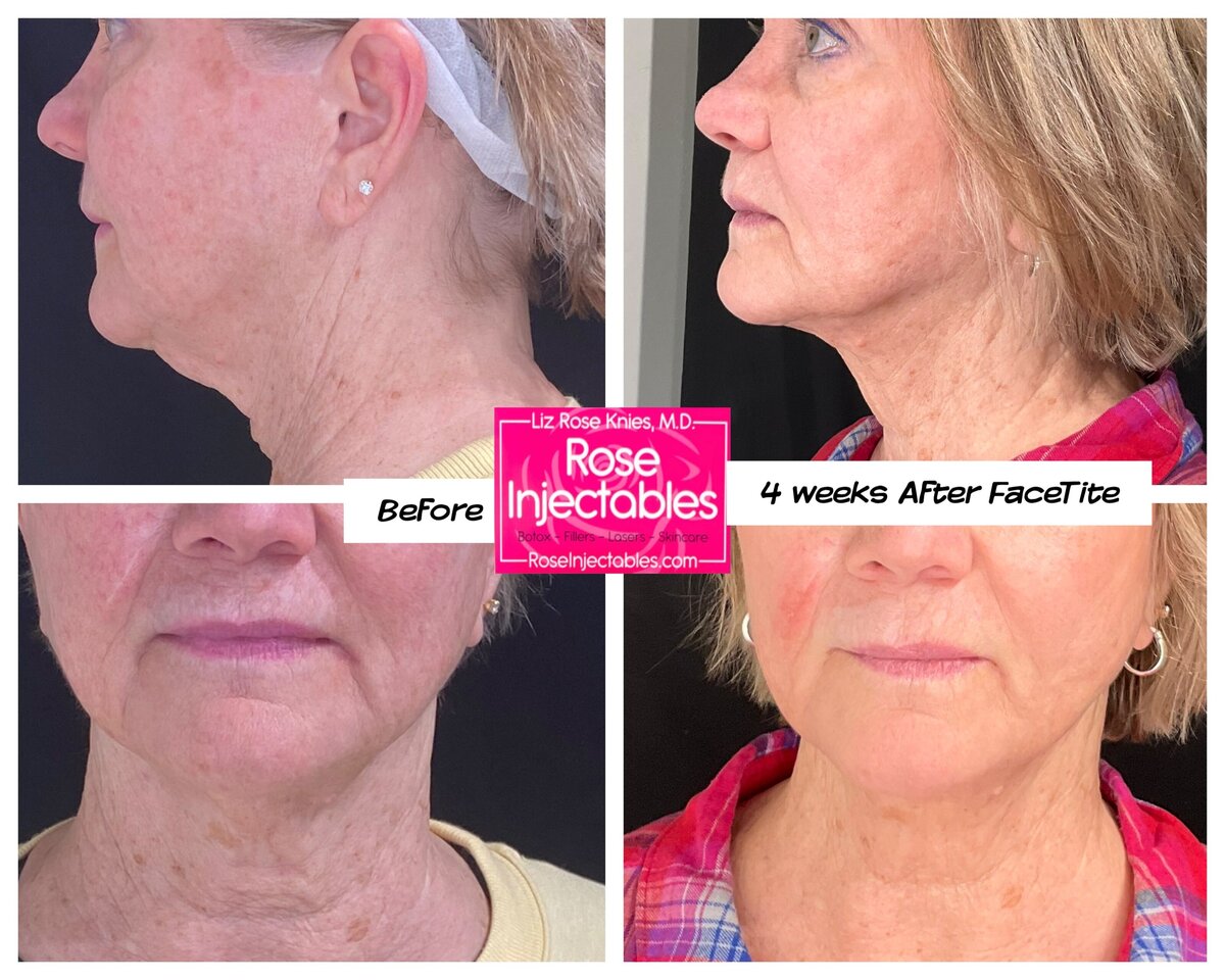 FaceTite-by-Rose-Injectables-Minimally-Invasive-Face-Contouring-Before-and-After-Photos-39