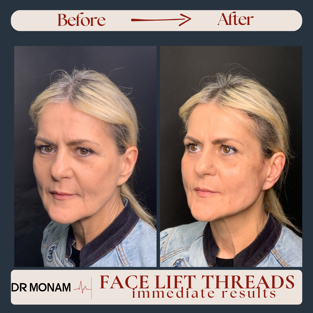 Neutral Before and After Instagram Post-21