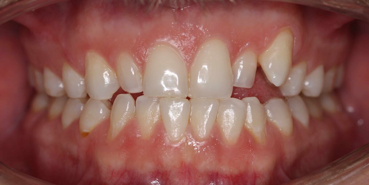 IMG_3191 before ortho_1