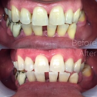 5bbd29cc926752c5a1c33690_before-after-12-zoom-whitening.JPEG