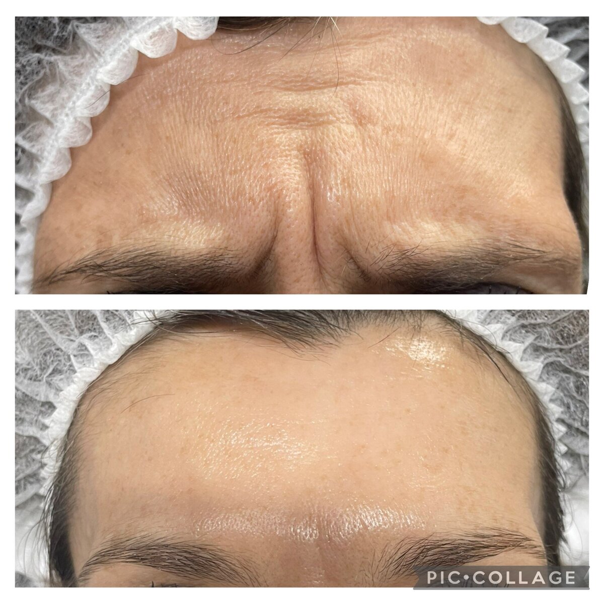 antiwrinkle injections in norwich based clinic aesthetic practitioner