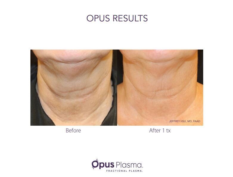 Opus Results Picture 4