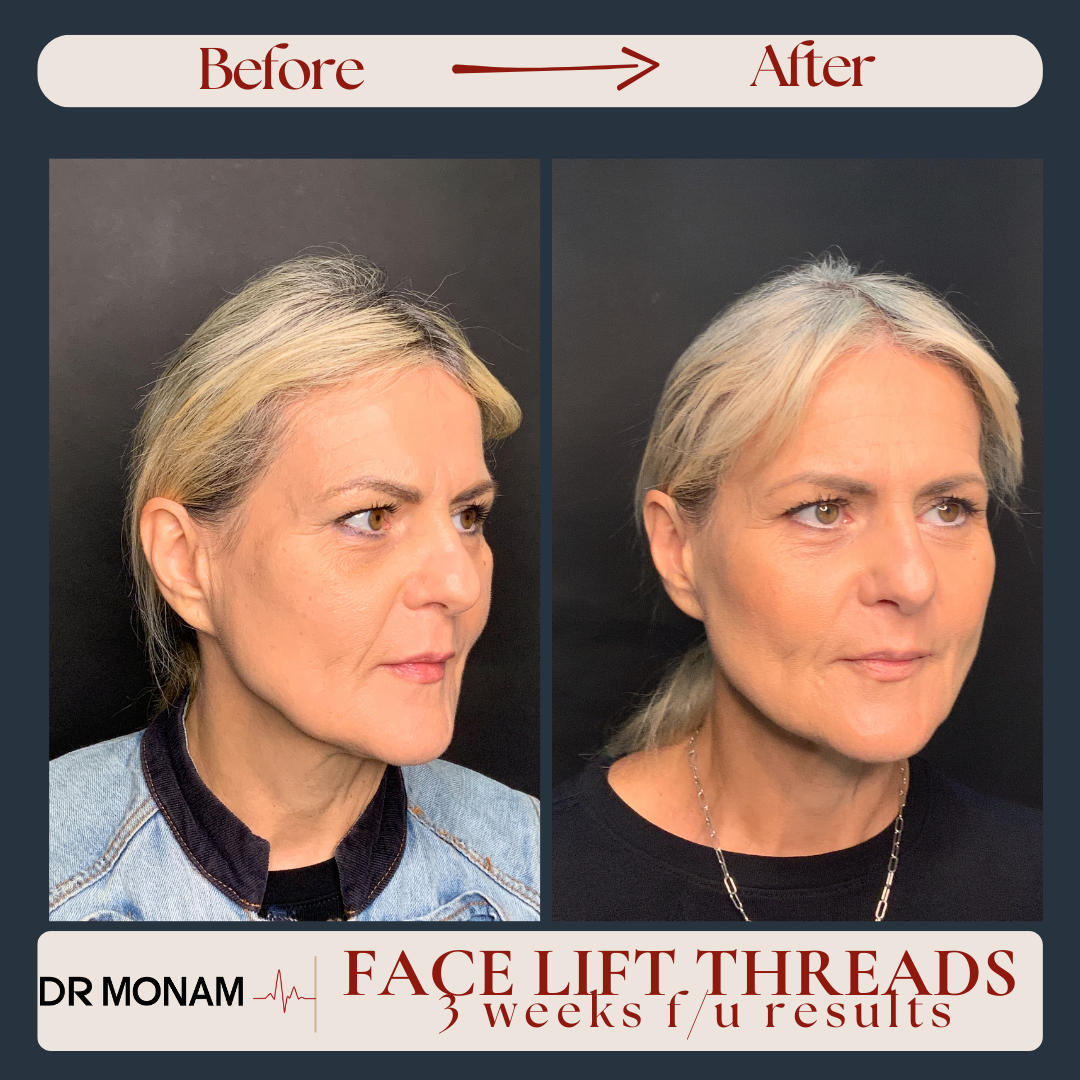 Neutral Before and After Instagram Post-22