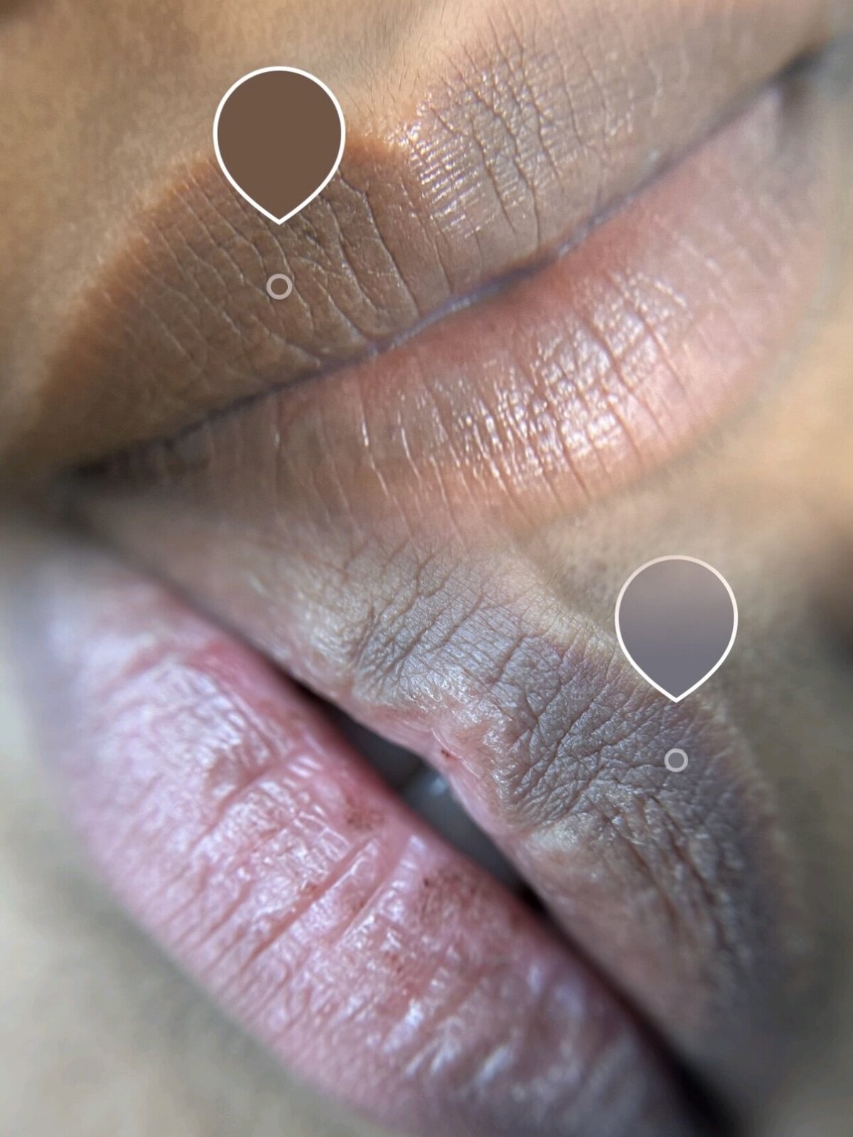 Lips Neutralization Dark Lips Color Correction New York