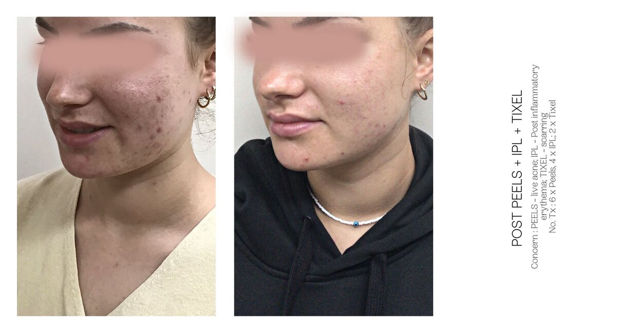 Acne Scarring Before and After 4