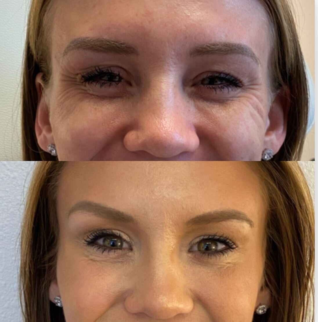 compressed-Neuromodulator-before-after-04