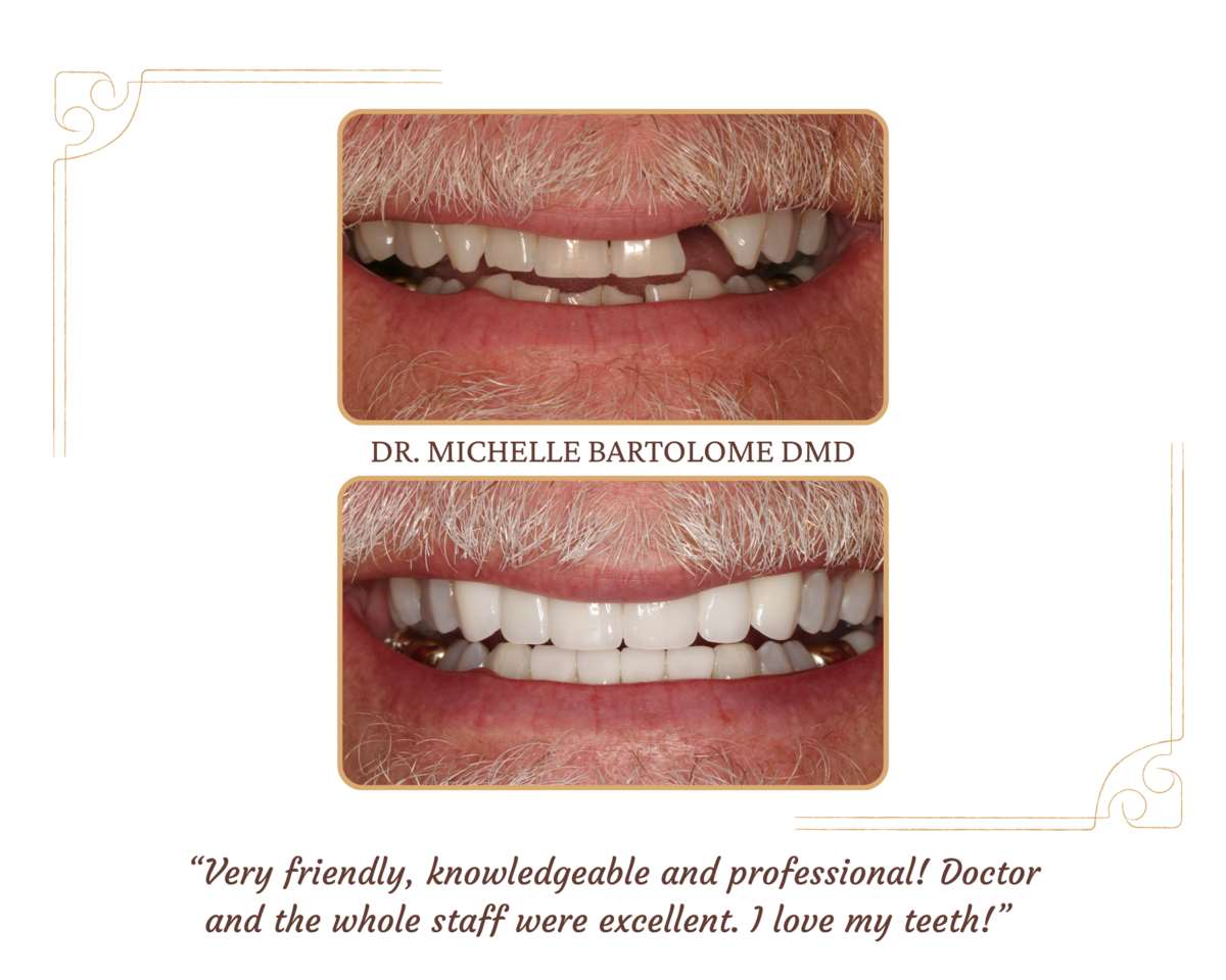 Replace Missing Teeth