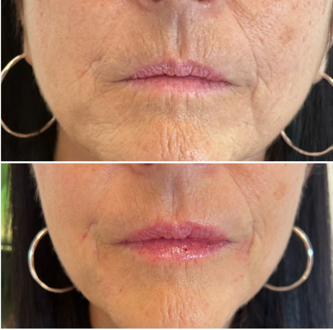 compressed-Lip-Wrinkles- Lip-volume-nd-some-brand-pics-20