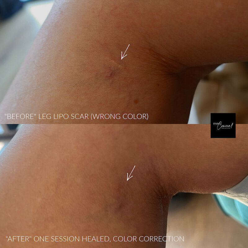 leg-lip-scar-camouflage-tattoo-2
