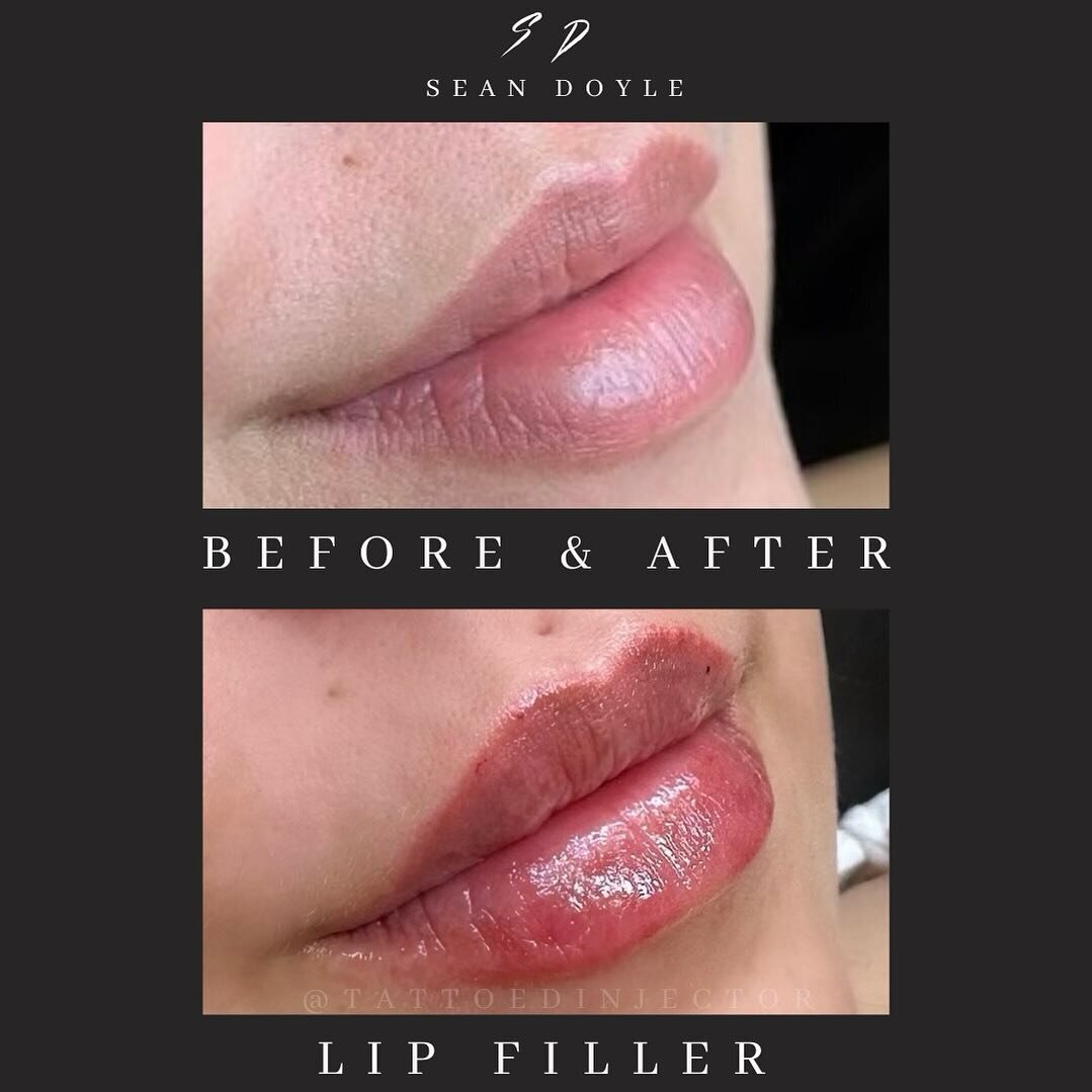 Lip Filler Before and After Scottsdale