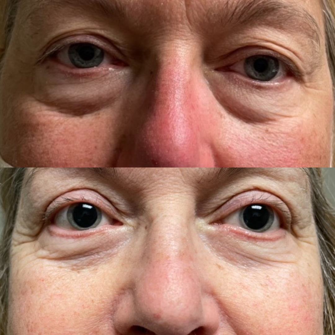Upper and lower eyelid blepharoplasty