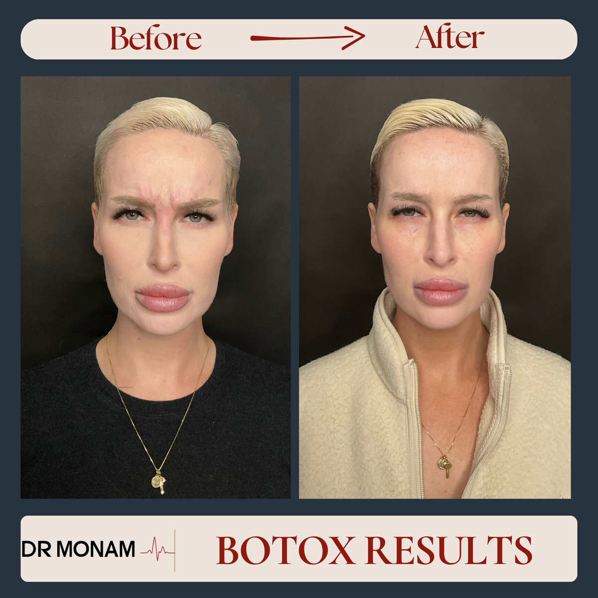 Neutral Before and After Instagram Post-2
