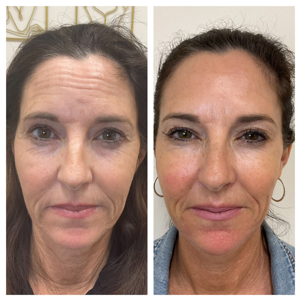 Smoother skin dysport Xeomin Botox medspa Carlsbad