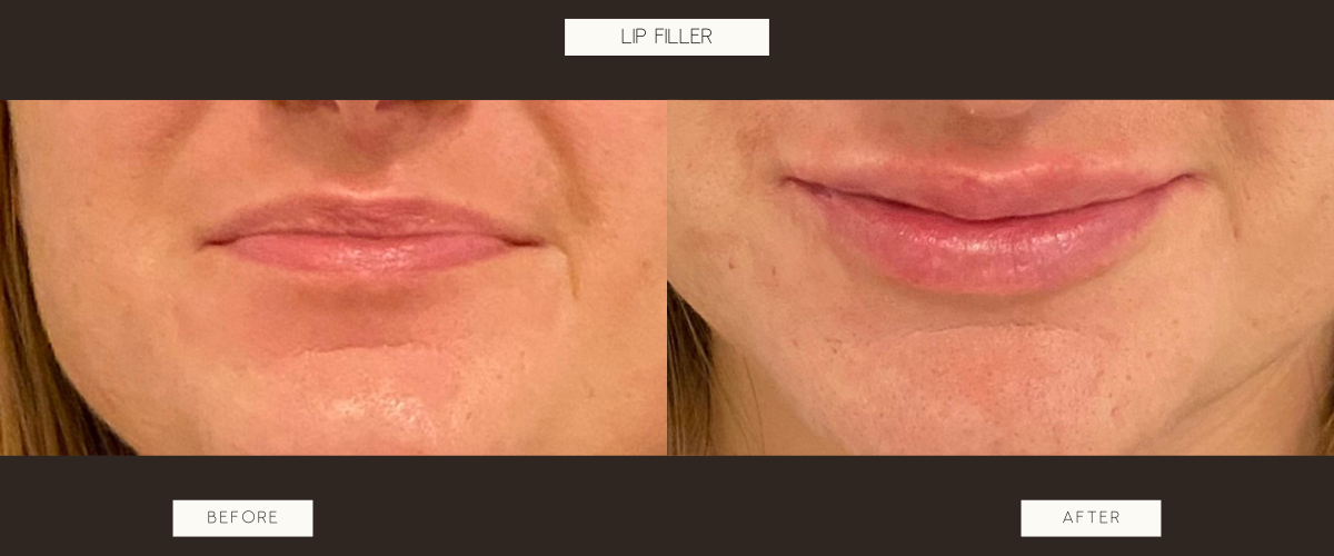 Lip Filler Before and After from Peace, Love, Beautiful Medspa Marietta, OH