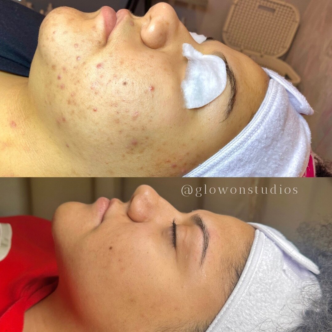 Glow-On-Studios-Before-After-Skincare-Sacramento-7