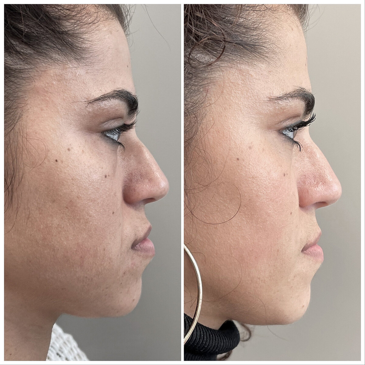 Before after fillers door Dr Lizenka Adriaanse cosmetisch arts Rotterdam