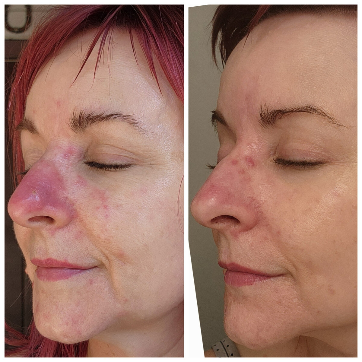Transformation of a rosacea-prone nose with lessened redness and skin texture irregularities