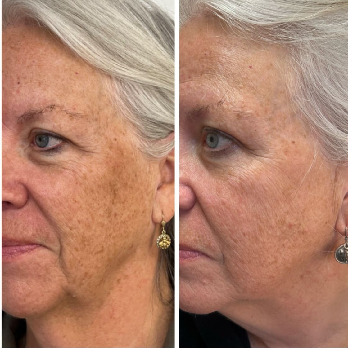 bbl-before-after-08