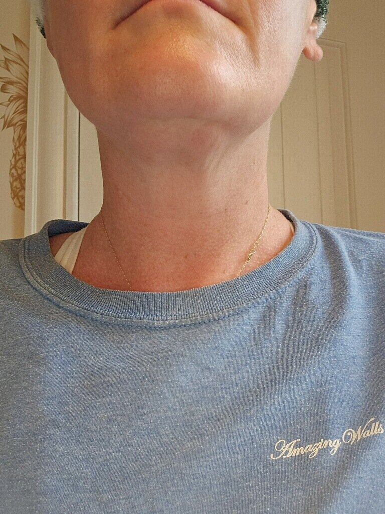 RF neck after 2 looking straight