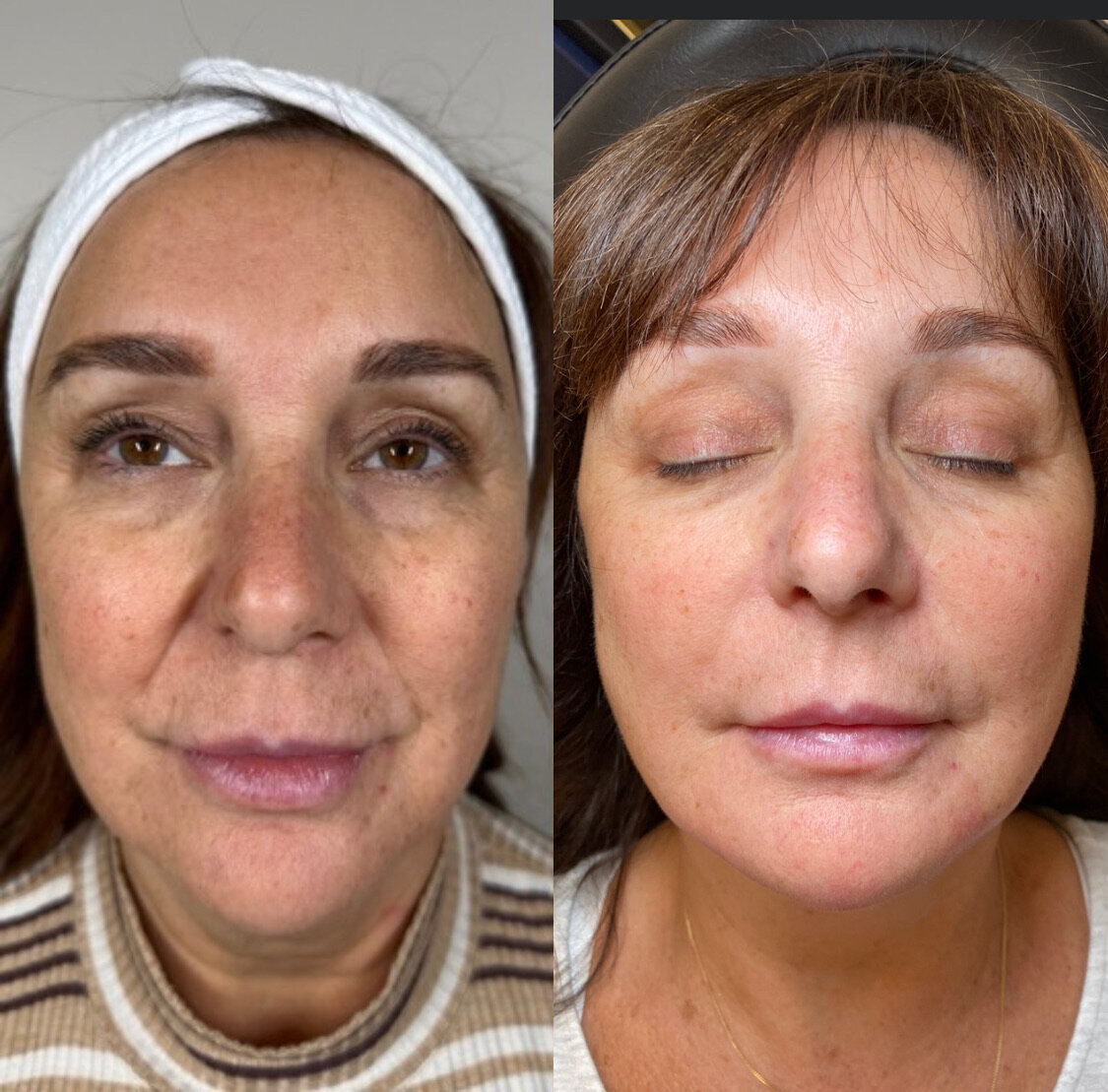 BalancedBeautyBotoxWestwood35
