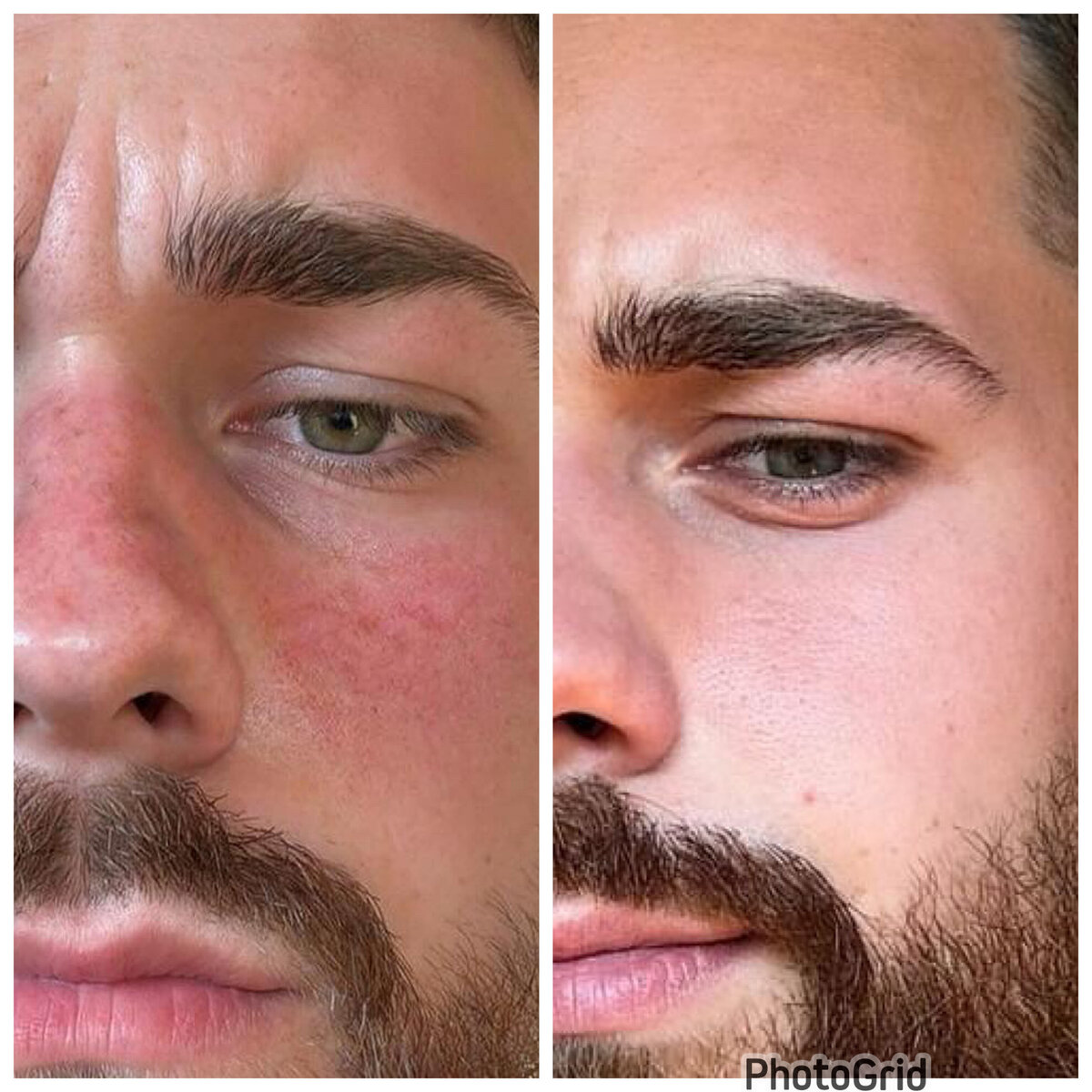 Rosacea remission results showcasing clearer skin achieved with holistic skincare by Dr. Tara O’Desky.